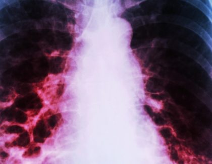 Asma y exacerbación de bronquiectasias