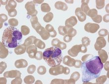 Early Mepolizumab Plus Glucocorticoids in Newly Diagnosed Eosinophilic Granulomatosis With Polyangiitis: A 52-Week Multicenter Retrospective Cohort Study