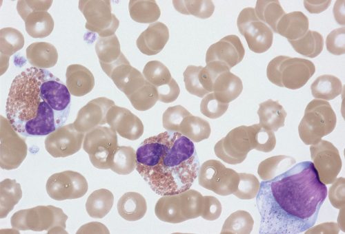 Early Mepolizumab Plus Glucocorticoids in Newly Diagnosed Eosinophilic Granulomatosis With Polyangiitis: A 52-Week Multicenter Retrospective Cohort Study