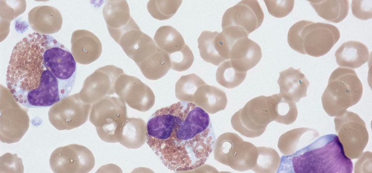 Early Mepolizumab Plus Glucocorticoids in Newly Diagnosed Eosinophilic Granulomatosis With Polyangiitis: A 52-Week Multicenter Retrospective Cohort Study